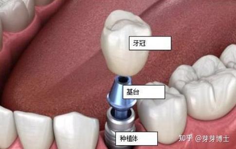 北京种牙哪种比较好？种植体品牌、材料如何选？-图3