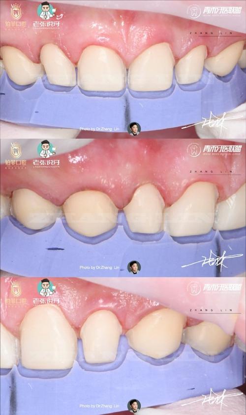 贴面切端预备方法图片-图1