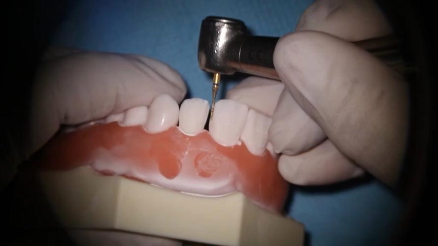 贴面切端预备方法图片-图2 贴面切端预备方法图片-图2