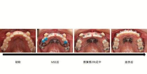 如何用图片测量正畸拥挤度？-图2