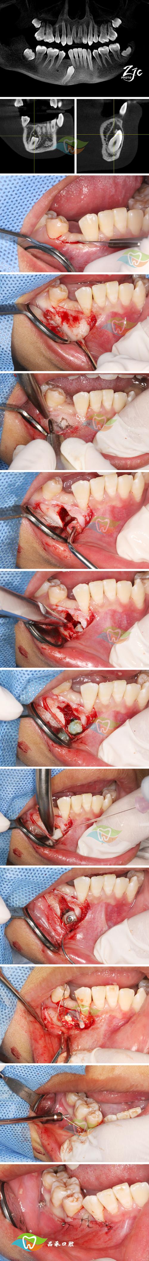 正畸治疗过程中牙周组织损害的常见类型有哪些？如何科学预防与处理？-图1