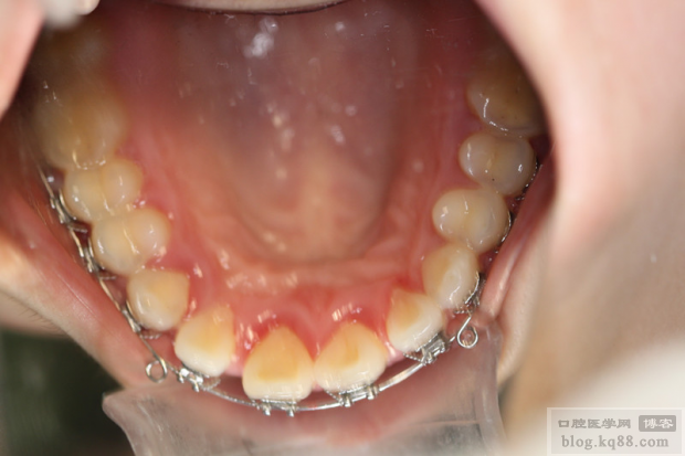 正畸治疗过程中牙周组织损害的常见类型有哪些？如何科学预防与处理？-图3