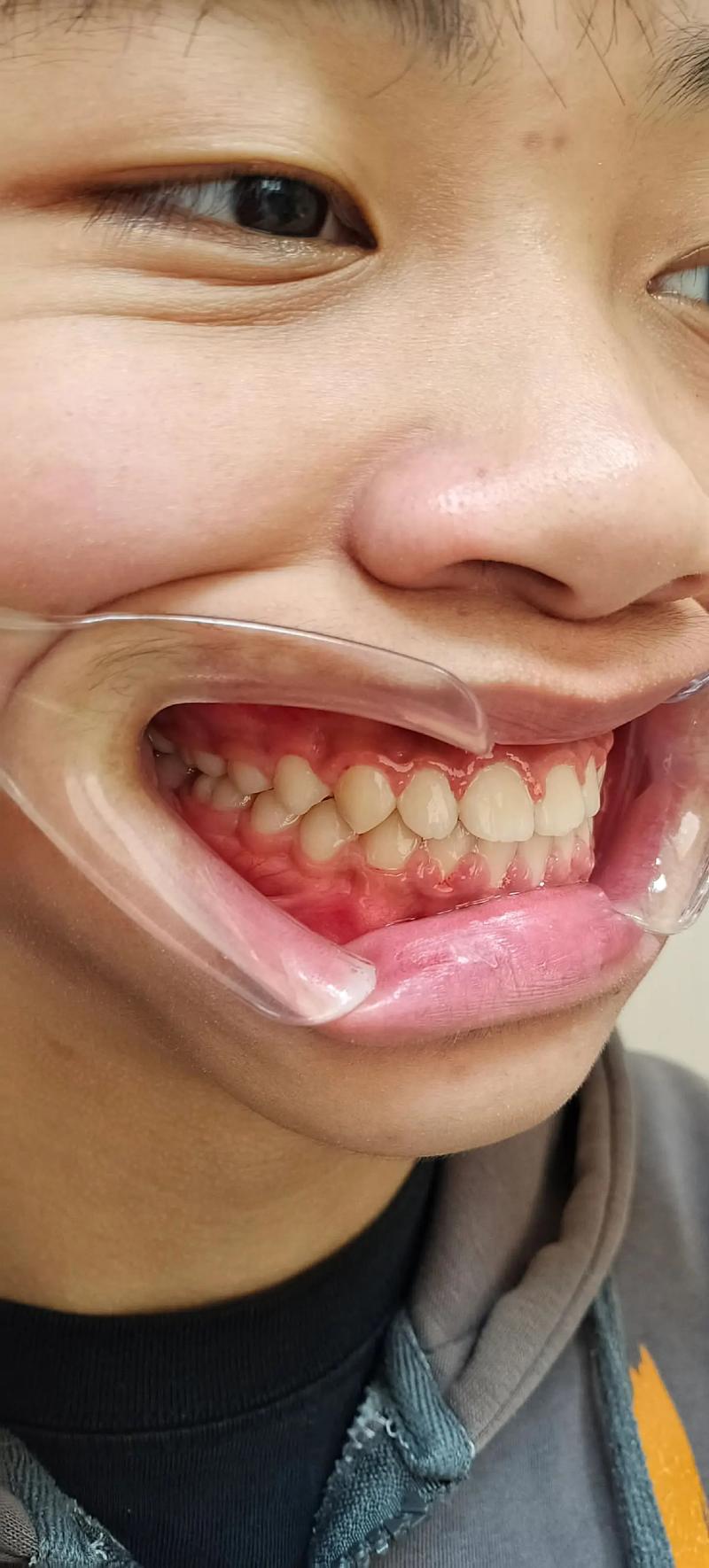 地包天 先手术 后正畸-图1 地包天 先手术 后正畸-图1