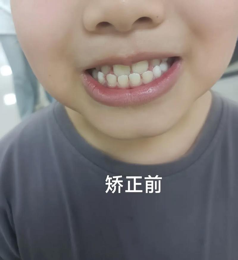 地包天 先手术 后正畸-图3