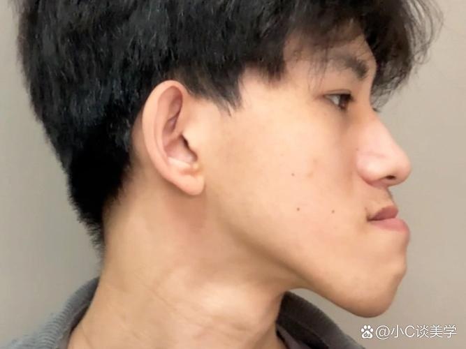 少年地包天正畸过程需要经历哪些步骤？-图3