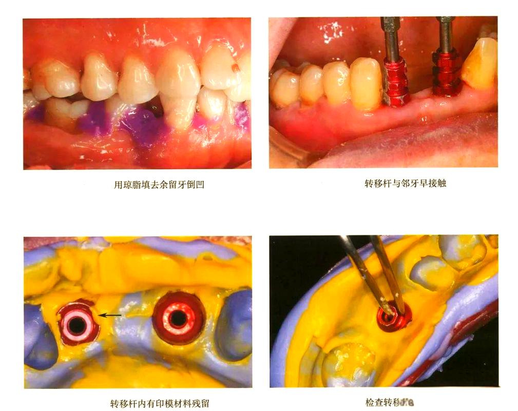 种植修复印模方法如何分类？常见分类标准及临床意义？-图1