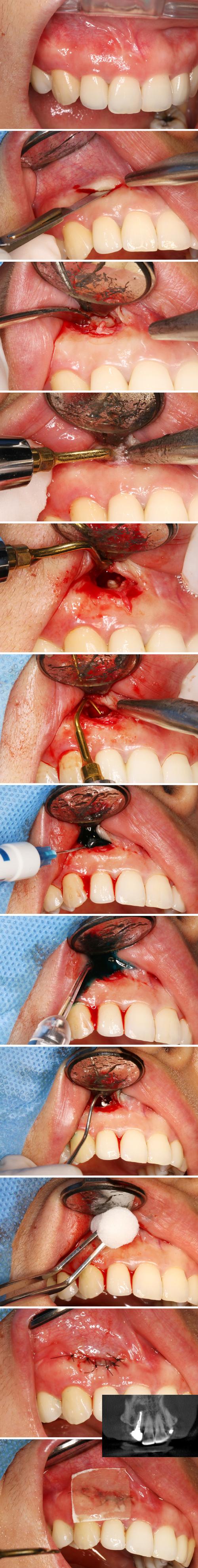 牙周改良隧道手术方法-图2