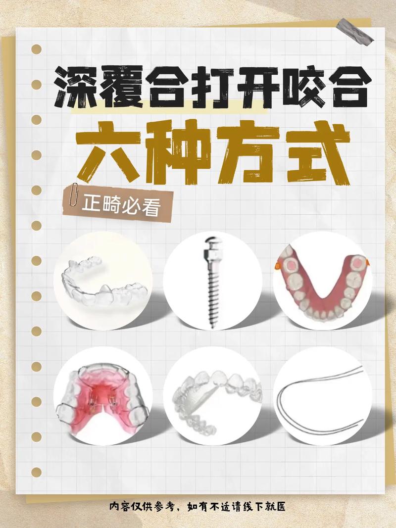 正畸打开深覆合咬合，有哪些常用安全有效方法及适用人群？-图2