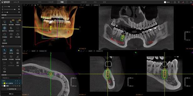 牙齿全景ct操作方法-图3
