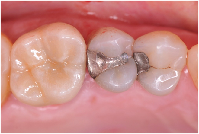 后牙折的修复治疗方法-图3 后牙折的修复治疗方法-图3