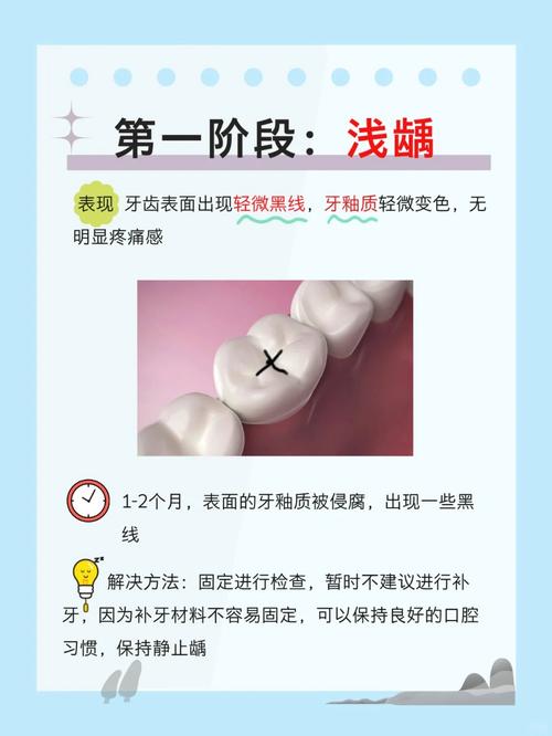 蛀牙龋齿有哪些有效治疗方法?如何选择适合自己的治疗方式?-图1 蛀牙龋齿有哪些有效治疗方法?如何选择适合自己的治疗方式?-图1