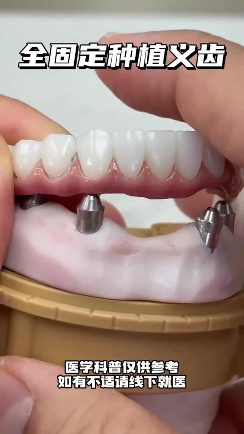 种牙手术后旁边牙活动，是何原因？-图1