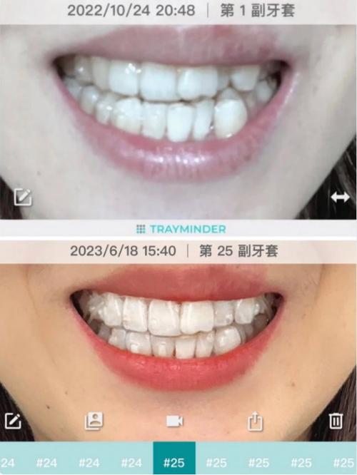 如何正确佩戴时代天使双膜?-图2 如何正确佩戴时代天使双膜?-图2