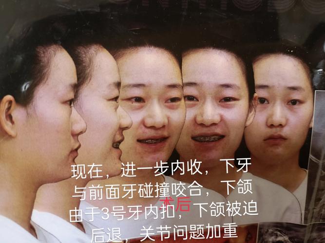 上海拜博口腔正畸效果如何?价格贵不贵?技术靠谱吗?-图2 上海拜博口腔正畸效果如何?价格贵不贵?技术靠谱吗?-图2