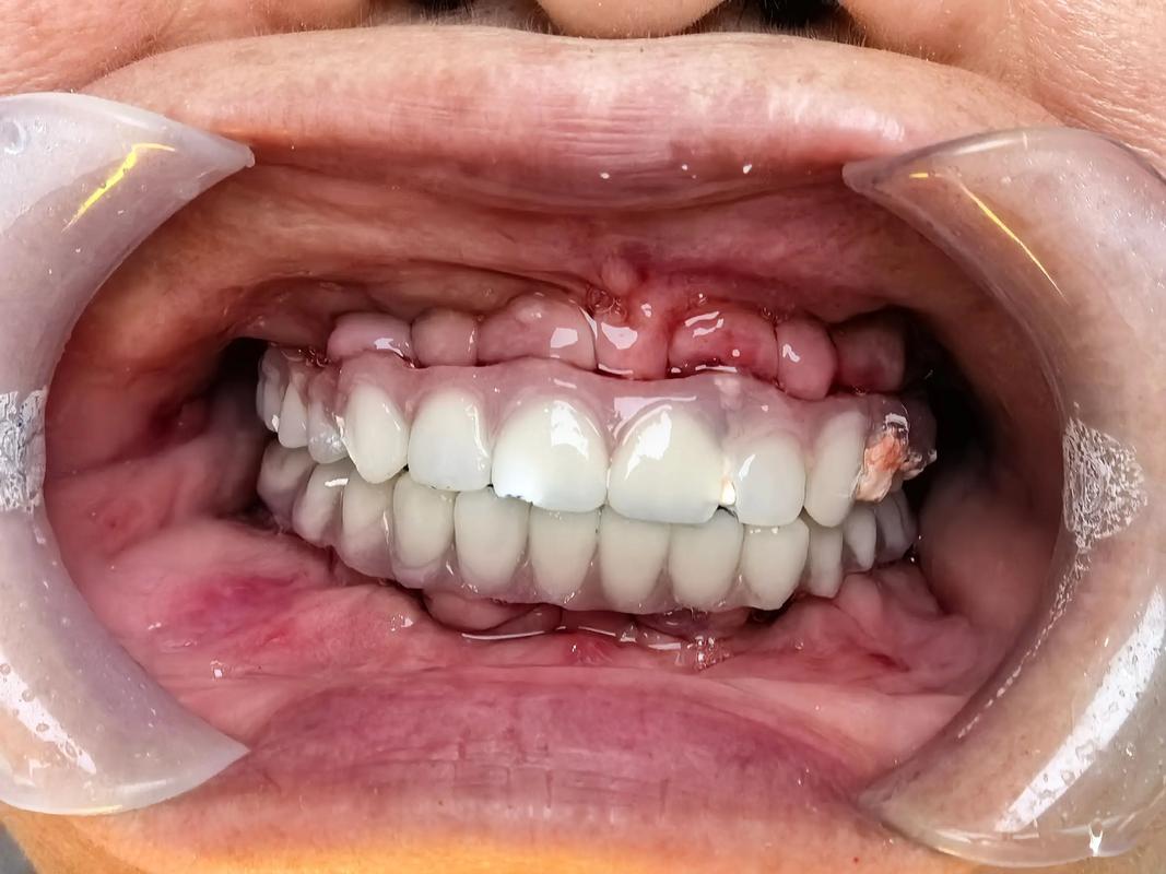 种牙期间临时牙能用吗-图2