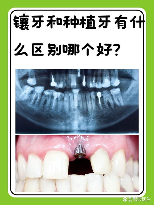 以色列vs韩国种牙，效果、价格、技术如何选？-图1