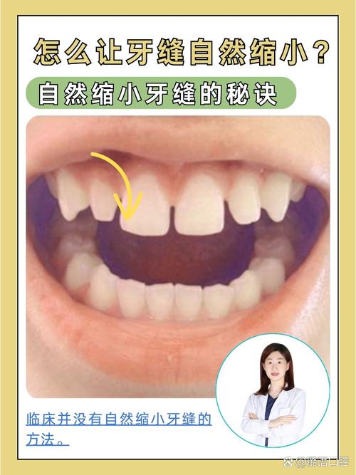 牙齿有缝隙用什么方法-图2