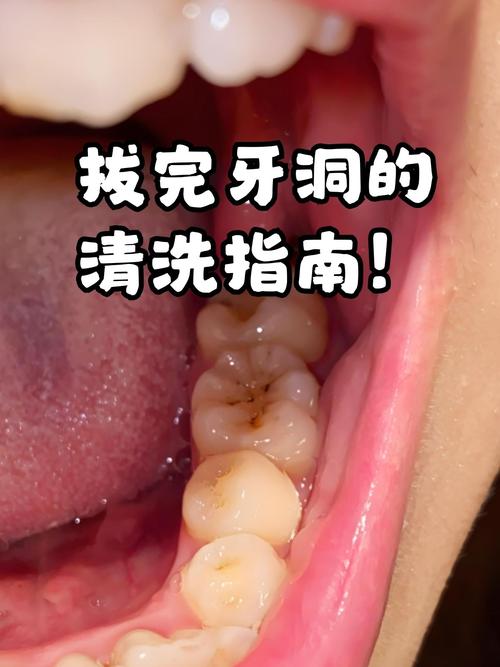 拔牙后创口如何护理？正确处理方法有哪些？-图3