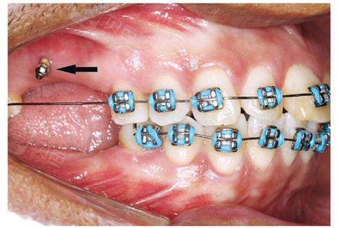 正畸支抗钉后脸肿化脓？怎么回事？原因是什么？-图2