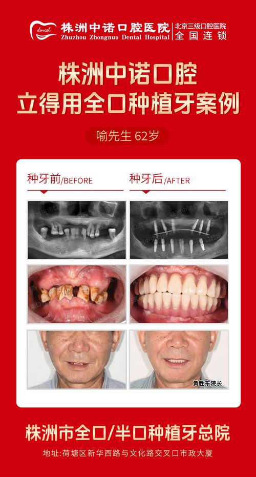 种牙种植体越贵越好吗-图2