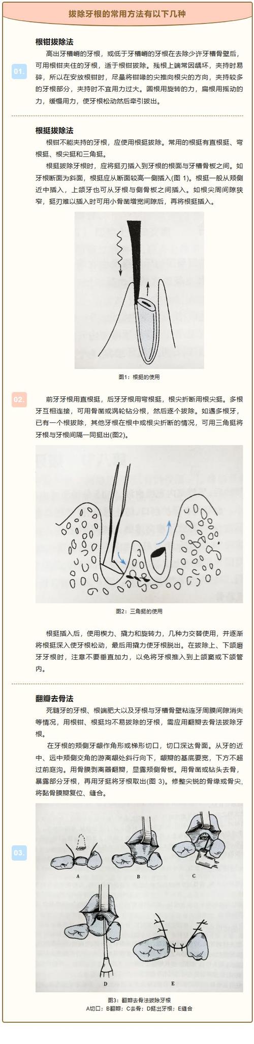 上颌中切牙拔除的正确操作步骤与方法技巧有哪些?-图2 上颌中切牙拔除的正确操作步骤与方法技巧有哪些?-图2