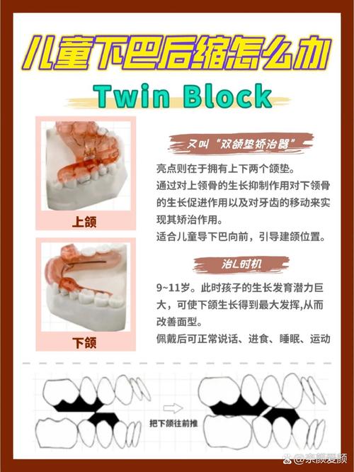 正畸TB与SGTB的区别究竟是什么？关键差异点及临床应用解析？-图1