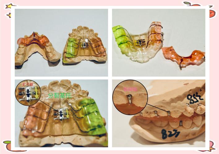 正畸TB与SGTB的区别究竟是什么？关键差异点及临床应用解析？-图2