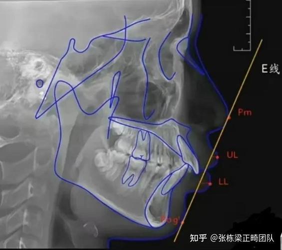 牙科X光拍摄角度怎么选？方法步骤与不同牙位应用技巧-图2