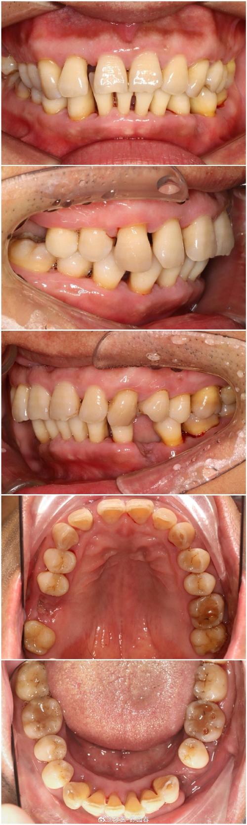 正畸期间发现牙周病，矫正会加重病情吗？如何兼顾治疗？-图1