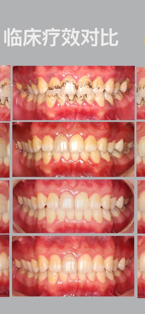 正畸期间发现牙周病，矫正会加重病情吗？如何兼顾治疗？-图2