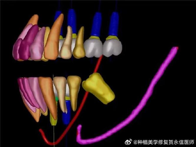 如何用最简单的方法调整磨牙倾斜？-图2