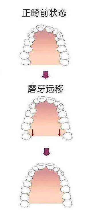 如何用最简单的方法调整磨牙倾斜？-图1