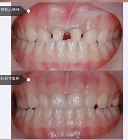 正畸与美容牙冠，如何根据需求选对牙齿改善方案？-图2