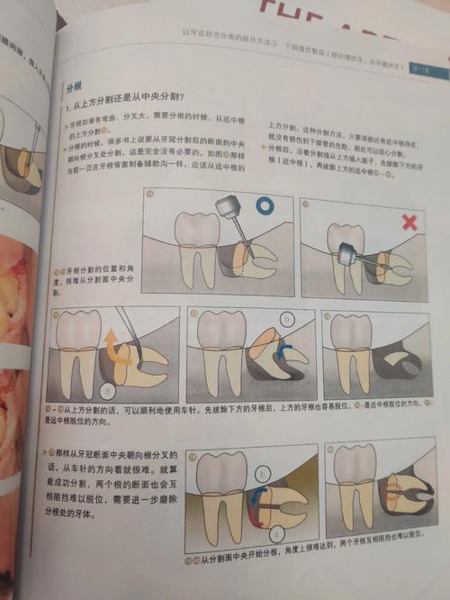 拔牙的步骤方法有哪些-图3