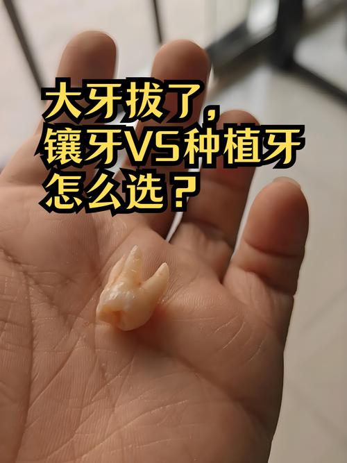 拔牙4年了，现在还能种牙吗？-图2