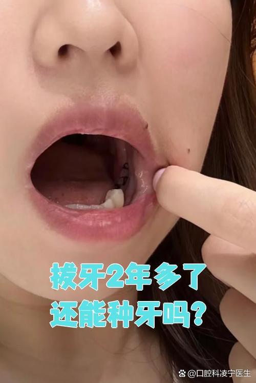 拔牙后隔2年种牙行吗-图1