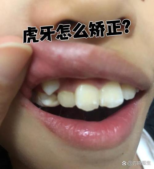 上海虎牙矫正的好方法有哪些?求推荐效果好、价格合理且靠谱的?-图3 上海虎牙矫正的好方法有哪些?求推荐效果好、价格合理且靠谱的?-图3