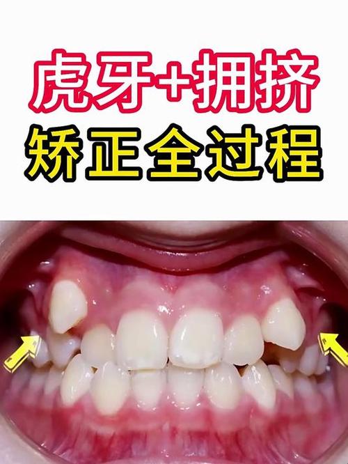 上海虎牙矫正的好方法有哪些?求推荐效果好、价格合理且靠谱的?-图2 上海虎牙矫正的好方法有哪些?求推荐效果好、价格合理且靠谱的?-图2