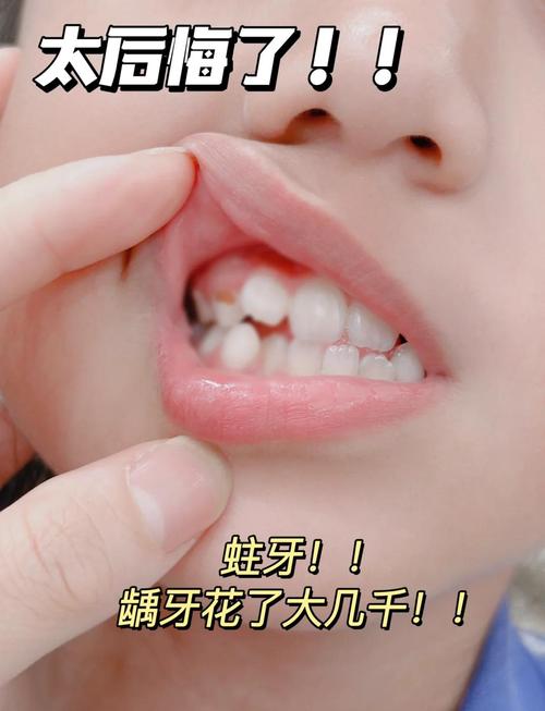 小孩蛀牙用什么好方法能安全解决?-图1 小孩蛀牙用什么好方法能安全解决?-图1