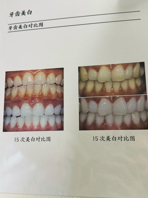天然牙颜色的测定方法-图1