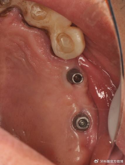 口腔穿孔有哪些治疗方法？如何选择合适方案？-图2