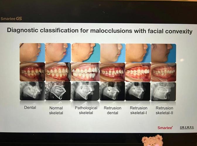 正畸联合创新Damon，疗效提升有何新突破？-图2