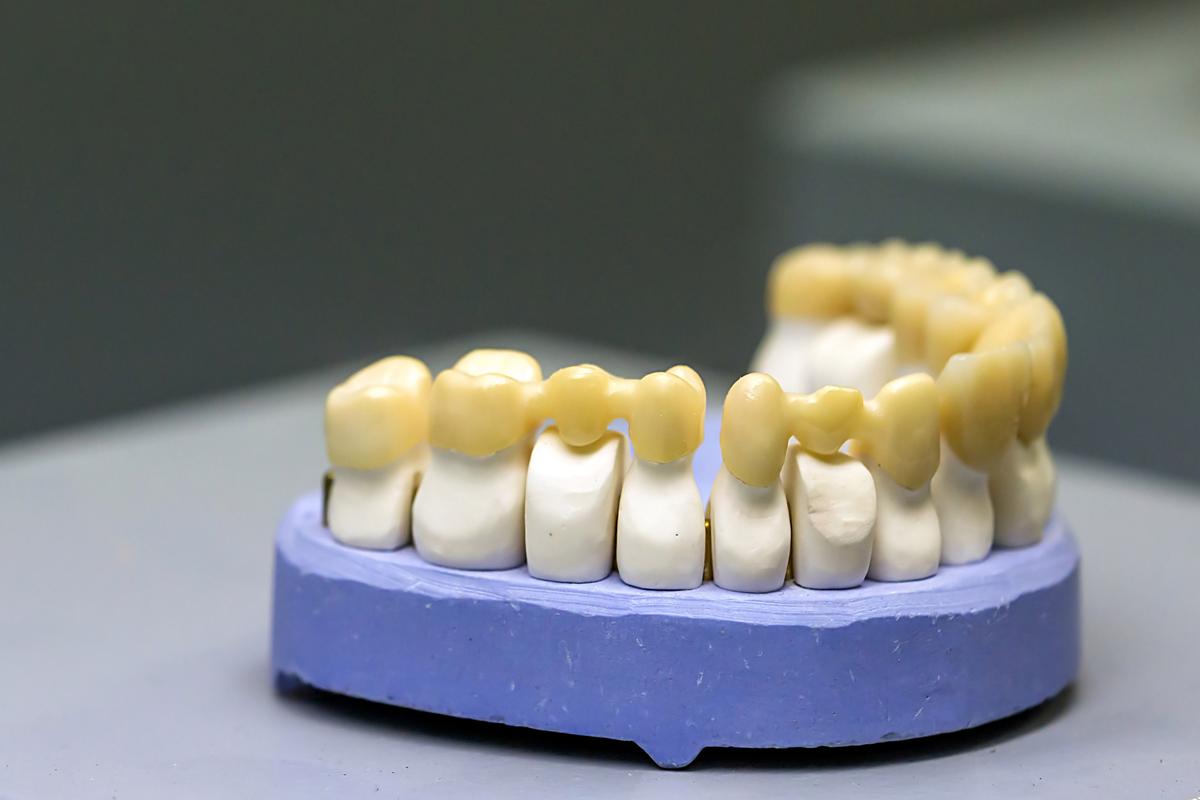 种牙后牙冠选什么材质？不同材质优缺点如何挑选合适？-图1