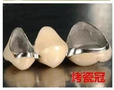 种牙后牙冠选什么材质？不同材质优缺点如何挑选合适？-图3