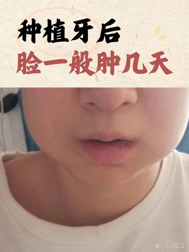 刚种完牙后会有哪些常见症状?-图1 刚种完牙后会有哪些常见症状?-图1