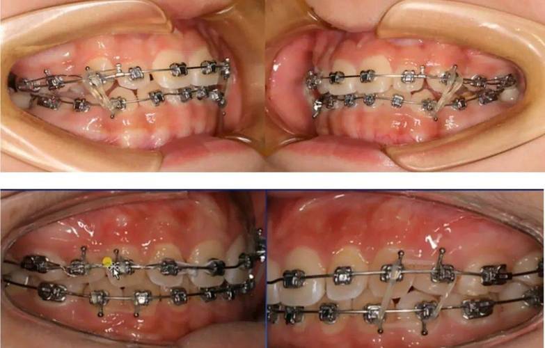 开颌正畸牙齿牵引方法-图2