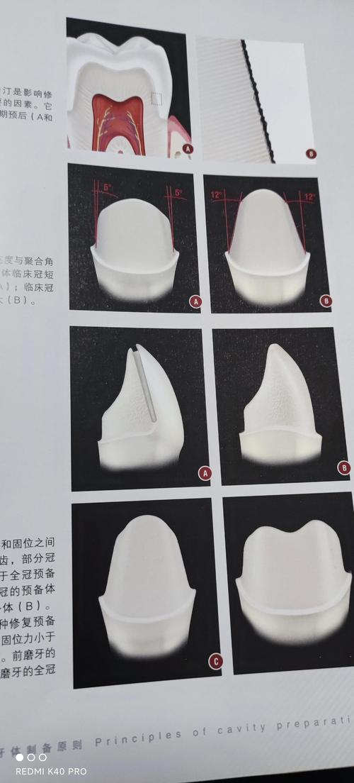 不良修复体制备方法存在哪些常见问题?如何通过改进方法提升质量?-图1 不良修复体制备方法存在哪些常见问题?如何通过改进方法提升质量?-图1