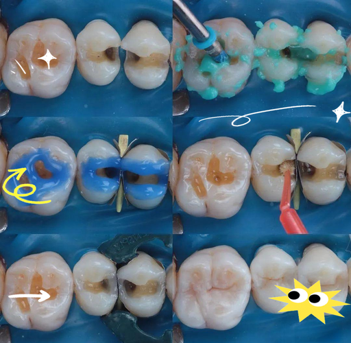 不良修复体制备方法存在哪些常见问题?如何通过改进方法提升质量?-图2 不良修复体制备方法存在哪些常见问题?如何通过改进方法提升质量?-图2