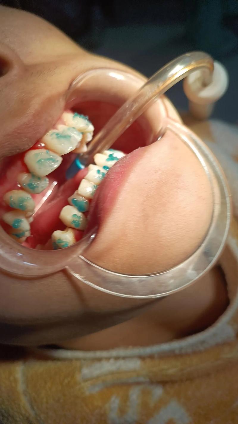 dolphin正畸视频-图1