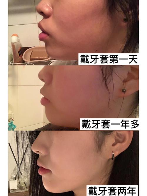 中外正畸有何不同？技术理念效果差异大吗？-图1